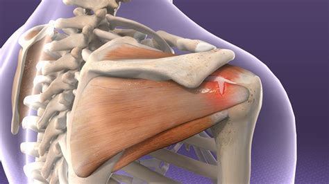 Rotator Cuff Tear Usa Spine Care And Orthopedics