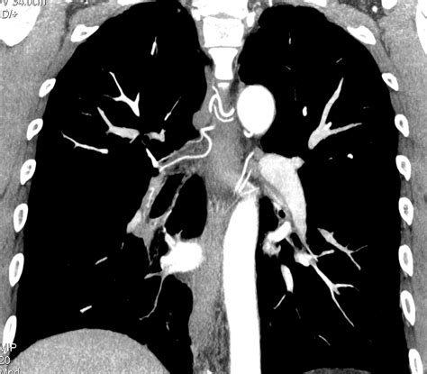 Ct Pulmonary Angiography Ctpa Pvri