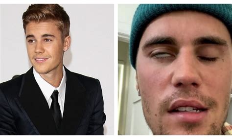 Justin Bieber a transmis un nou mesaj îngrijorător după ce a confirmat că suferă de paralizie