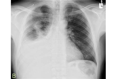 Radiographic Representations Of Hydrothorax And Its Effects On The
