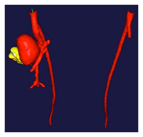 Ct Angiogram Showing The Left Profunda Femoris Artery Pseudoaneurysm