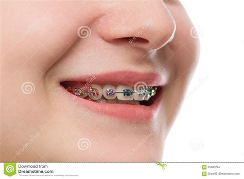Closeup Multicolored Braces On Teeth Beautiful Female Smile Portrait With Self Ligating Braces