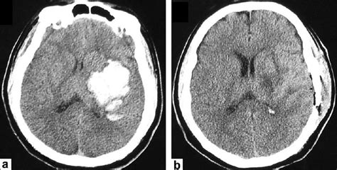 Dangerous strokes can occur here. View Image