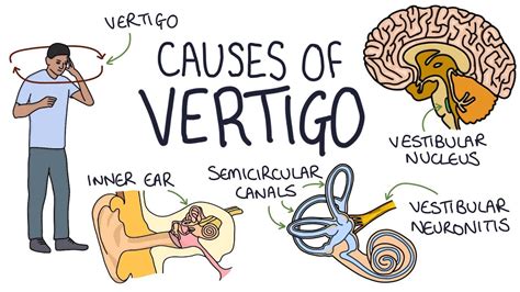 Understanding The Causes Of Vertigo Youtube