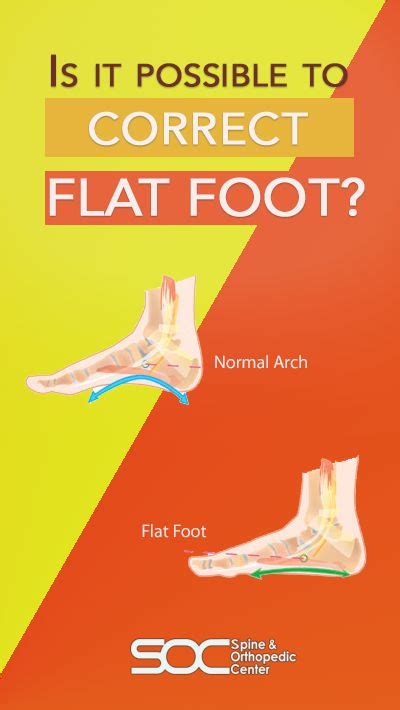 Is It Possible To Correct Flat Foot Yes It Is Most Flatfoot