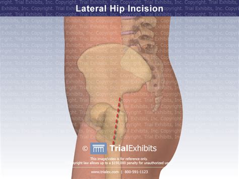 Lateral Hip Incision Trial Exhibits Inc