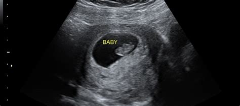 What Is The Earliest You Can See A Babys Heartbeat On An Ultrasound