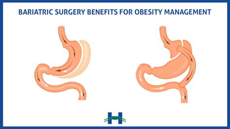 Bariatric Surgery Benefits For Obesity Management Mount Lebanon