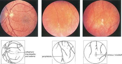 Intraocular Inflammation Ento Key