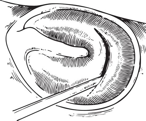 Therapeutic Wide Field Myringotomy Ento Key