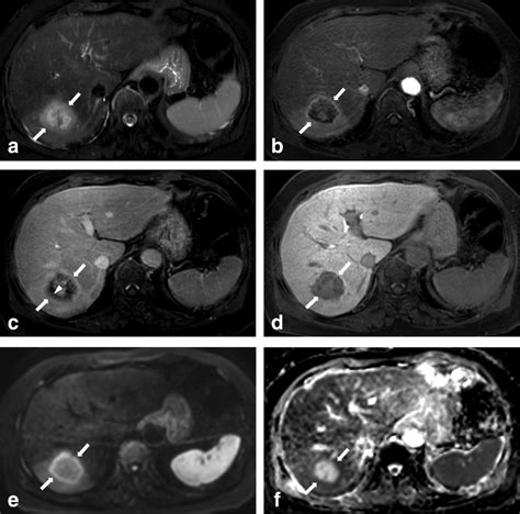 Differentiating Hepatic Abscess From Malignant Mimickers Value Of