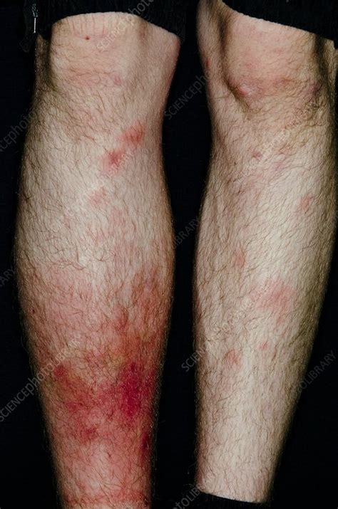 Cellulitis Of The Leg After Insect Bites Stock Image C0135799