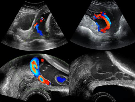 Case Visualization Using Colorcoded Doppler Ultrasound Of Fetal Sexiz Pix