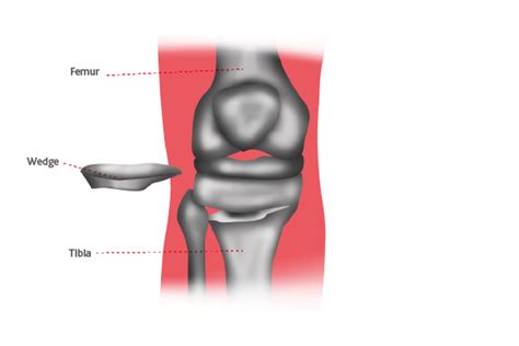 Knee Realignment Surgery Osteotomy Circle Health