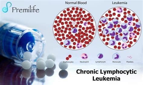 Chronic Lymphocytic Leukemia Premilife Homeopathic Remedies