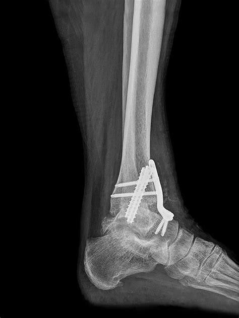 Mr Miles Callahan Ankle Fusion