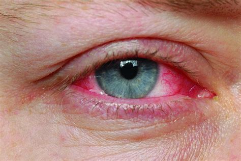 Conjunctivitis Recovery Eyesight