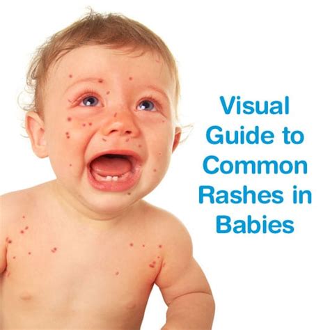 Baby Rash A Visual Guide To Skin Rashes In Babies And Children Images