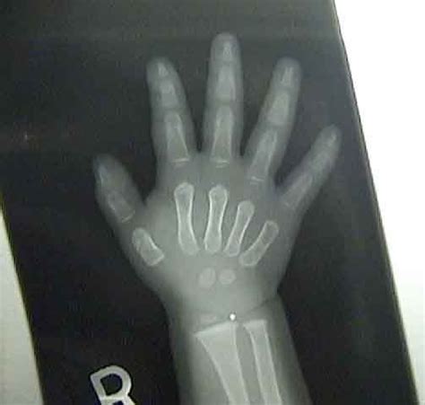 Geneticist — X Ray Of An Infants Hand Source Op Kids Hands X Ray