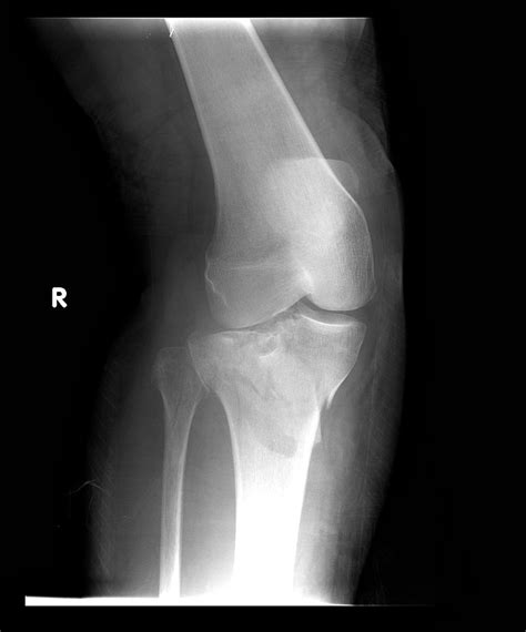 Tibial Plateau Fracture Or Broken Top Of The Shin Bone
