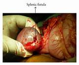 Fistula And Wound Management System Pictures