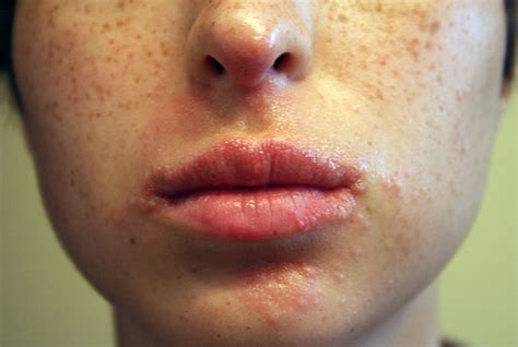 Pimples Around The Mouth