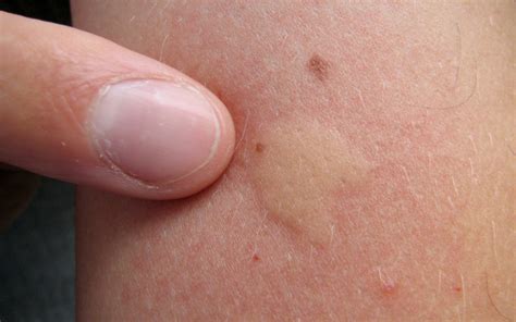 Itchy Red Bumps On Skin Like Mosquito Bites Better Health Channel