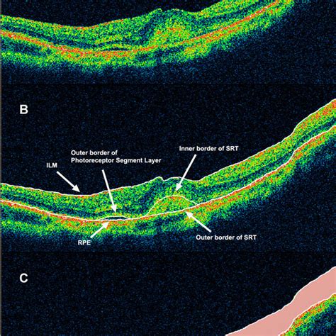 Optical Coherence Tomography B Scan Of An Eye With Cnv Secondary To