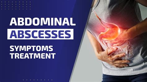Abdominal Abscesses Symptoms Diagnosis And Treatment Youtube