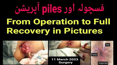 Fistula Operation In Pictures From Operation To Full Recovery Surgeon Dr Imtiaz Hussain Youtube