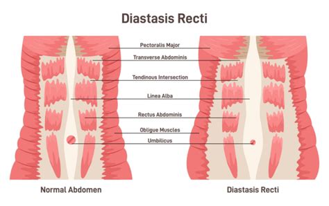 Diastasis Recti Physiotherapy Faqs And Myths Busted Sugbun
