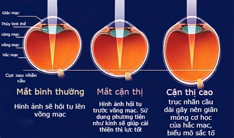 rất hay mắt cận nặng nhất là bao nhiêu độ những bệnh lý nguy hiểm dễ mắc phải khi cận thị nặng