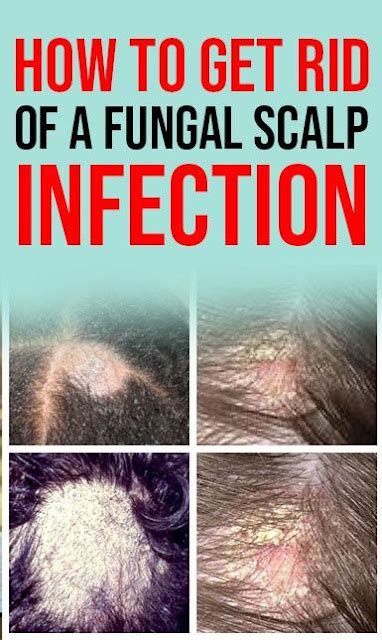 How To Get Rid Of A Fungal Scalp Infection Causes Symptoms And Natural Remedies Healthy