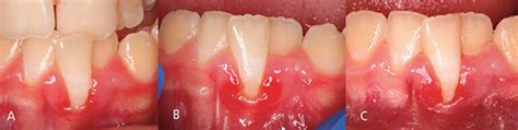 Diagnosis And Treatment Of Gingival Recession Decisions In Dentistry
