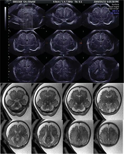 Tomographic Ultrasound Imaging Tui And Mr Imaging Of Hydrocephalus Ex