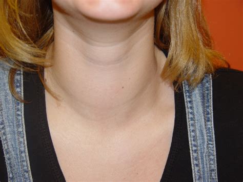 Goiter Symptoms Ask The Doctor And Be Healthy