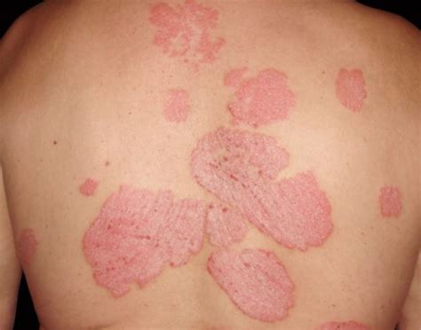 Skin Clearance Rates In Plaque Psoriasis Maintained Long Term With
