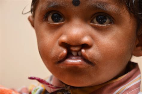 Follow through with any and all recommended aftercare appointments; Trinity Care Foundation: Free Cleft Lip Surgery in Bangalore