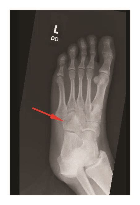 An X Ray Of The Left Foot Showed A Commuted Fracture Of The Cuboid Bone