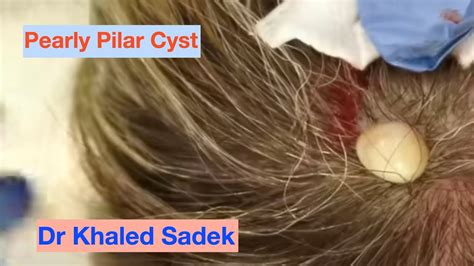 Complete Pilar Cyst Removal Dr Khaled Sadek Youtube