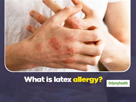 Latex Allergy Pictures