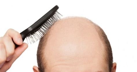 Hair Today Gone Tomorrow Joe Takes A Look At Receding Hairlines And