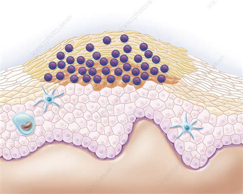 Wart Illustration Stock Image C0244223 Science Photo Library