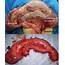 A Case Of Sigmoid Colon Duplication In An Adult Woman  BMJ Reports