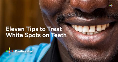 11 Tips To Treat White Spots On Teeth Positivemed