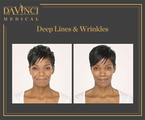 Da Vinci Clinic Deep Lines And Wrinkles Using Dermal Fillers Injection