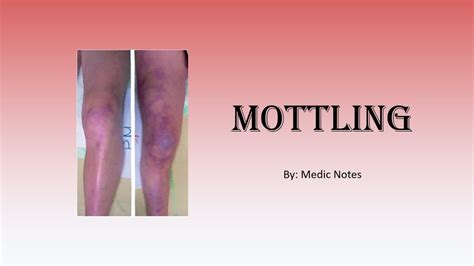 Skin Mottling Definition Causes Pathophysiology Sign Value Youtube