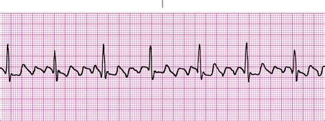 Picture Of Atrial Flutter