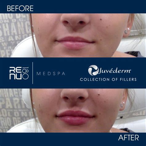 Where Can Juvederm Fillers Be Used On The Face Renu 180