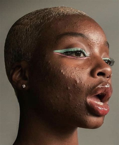 These Women Are Normalizing Acne On Social Media To Help Others ‘it